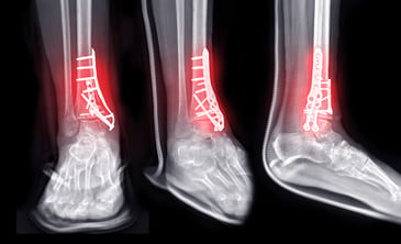 an x ray showing examples of devices medical device sales reps should know